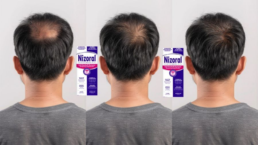 Flake-Free Confidence Is Nizoral Shampoo 2% Your Best Defense Against Dandruff?